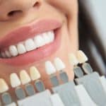 blanqueamiento dental